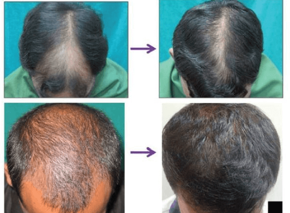 microneedling and minoxidil