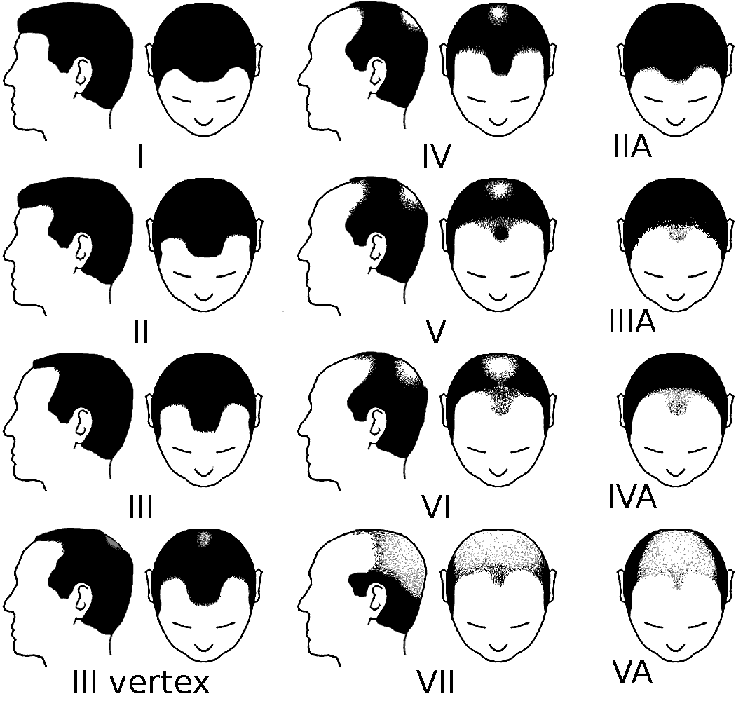Hamilton-Norwood scale