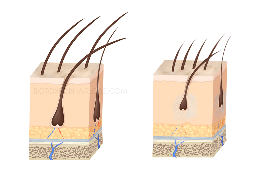 Hair follicle miniaturization