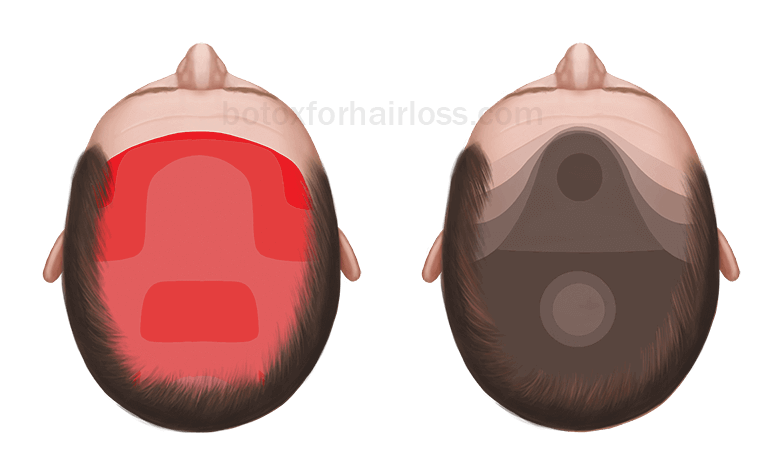 the correlation between tension and hair loss demonstrated more clearly